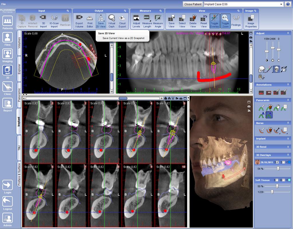 IMPLANT / CROSS SECTIONS TAB 9 IMPLANT / CROSS SECTIONS TAB In the 3D Cross Sections / Implant tab cross sectional slices, axial slices and panoramic images can be created from the 3D data.