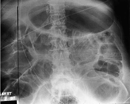 Image plate artifact The dark line along the lateral portion of this upper abdomen is caused by backscatter transmitted