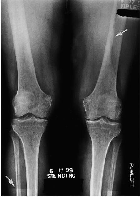 Plate reader artifacts Plate reader artefact. This bilateral knee image was spoiled when the incorrect erasure setting was used to eliminate a previous femur image.