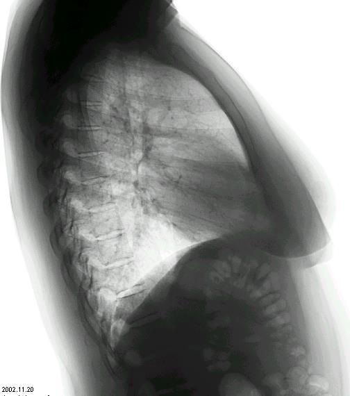 Chest image from a flat panel obtained at 75 kv (mistake, using abdomen protocol).
