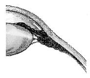 078 N) Zonular tension reduced (~0 N) Lens flatter (less power) Lens more curved (more power) Iris