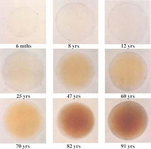 Scattering increases with ageing Lens yellowing