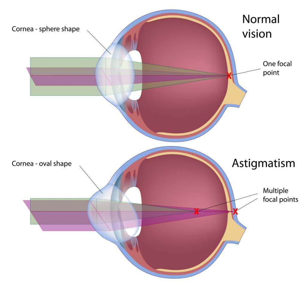 Astigmatic Eye - Correction
