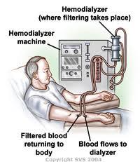 undergoing hemodialysis Advanced