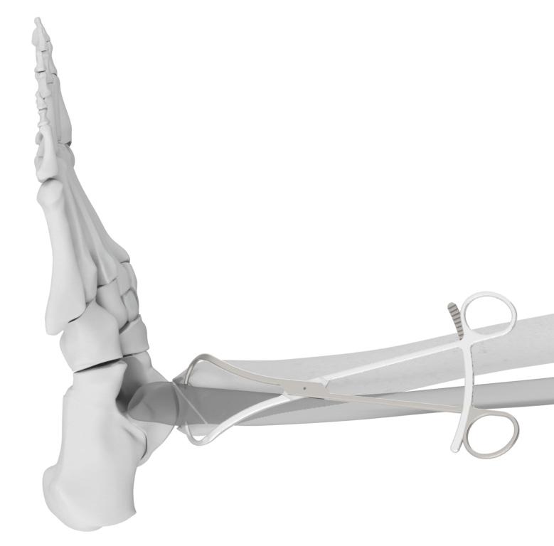 Step 2 Reduction The fracture can either be reduced percutaneously with reduction forceps or through a small incision.