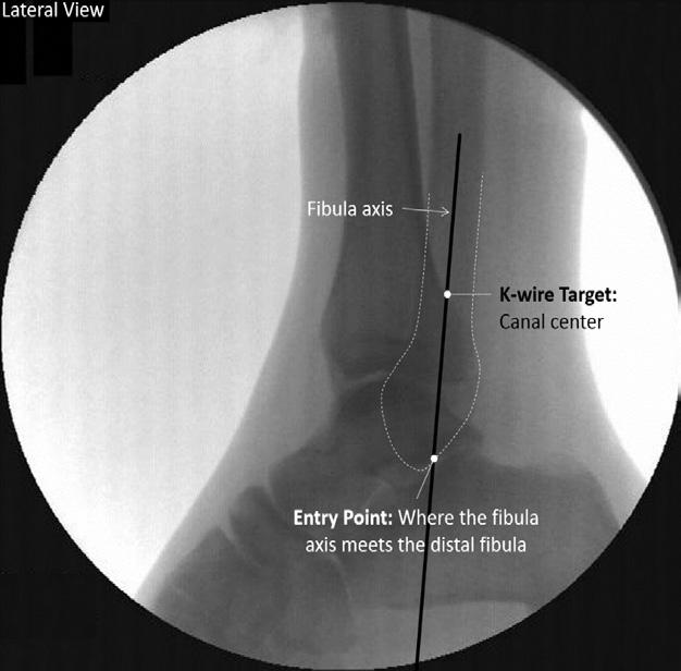 Lateral View: Aligned with canal axis A/P or Mortise View: At the