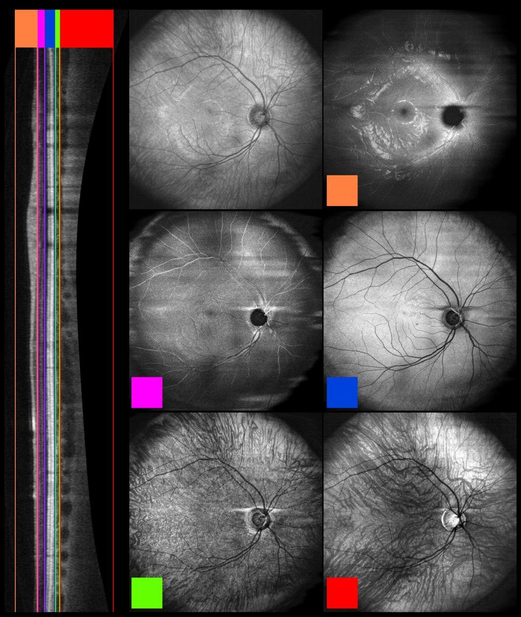 For 12x and 24x B-frame averaging, the combination of both speckle noise reduction and increased signal to noise ratio allows for clear identification of vessels in the sclera, which are not