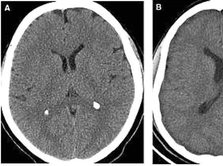 185 Fig. 3. Exemple de asimetrie ventriculară uşoară (A), moderată (B) şi severă (C) din: Kiroglu Y. et al. Cerebral lateral ventricular asymmetry on CT: how much asymmetry is representing pathology?