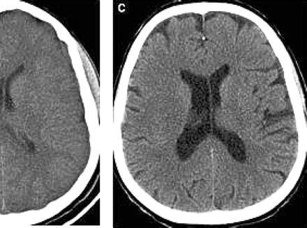 96% pentru coarnele temporale (0.15-0.25 cm³ din stânga vs. 0.17-0.27 cm³ din dreapta) [5]. Pentru coarnele frontale, studiul CT efectuat de Kiroglu et al.