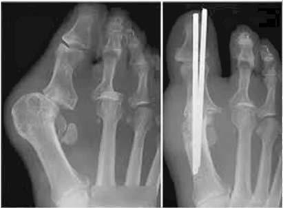 Distrugerea articulaţiei metatarso-falangiene pune la evidenţă în faţa chirurgului necesitate în efectuarea unei artrodezări [4].
