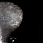 3 and Fig 4. Fig. 3: (a) Cranio Caudal view of Right breast Fig.