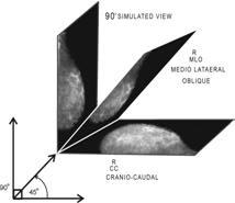 1. For R CC CRANIO CAUDAL. 2. For R MLO MEDIO LATAERAL OBLIQUE The practical plain mammography R CC ( cranio caudal) is taken.