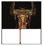 CT TECHNOLOGY SureView: uncompromising image quality A patented solution for multislice CT scanning, SureView provides exceptional image quality at any pitch setting.