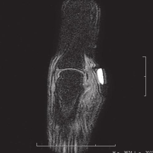 C D Figure 5. (A) Using conventional FatSat techniques in a 3:32 min. scan time, there is a failure of fat suppression in this thumb exam.