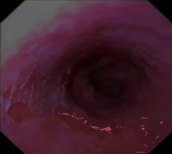 To achieve a better diagnosis by observing this kind of lesion, in order to select more accurately the areas to biopsy, several techniques to enhance endoscopic images have been developped.