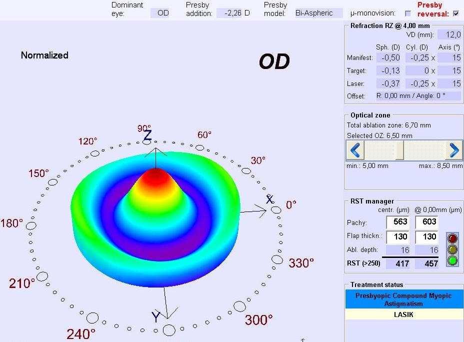 Aberration-Free treatment (with equal optical zone size to previous PresbyMAX procedure) can be performed on top for improved distance correction if reading quality (multifocality) is