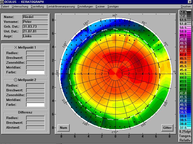 Distribution of asphericity in a normal population Mainly negative Q-values The mean shape of the human cornea P.