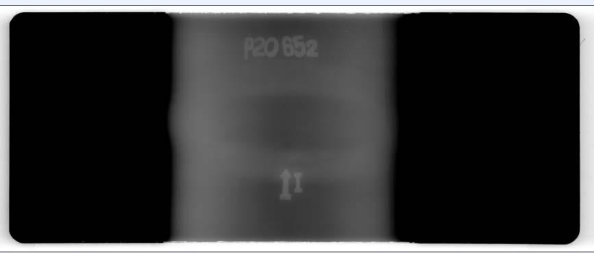 Figure 03.B: As received pipe radiograph obtained from CR system. Lack of Penetration Figure 03.C: Image enhanced pipe radiograph showing lack of penetration.
