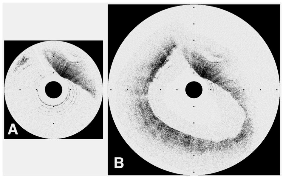Fig. 8. Images of a carotid plaque with a 6.0 mm maximum luminal diameter. A. Traditional OCT image demonstrates visualization of only a small portion of the arterial cross-section. B.