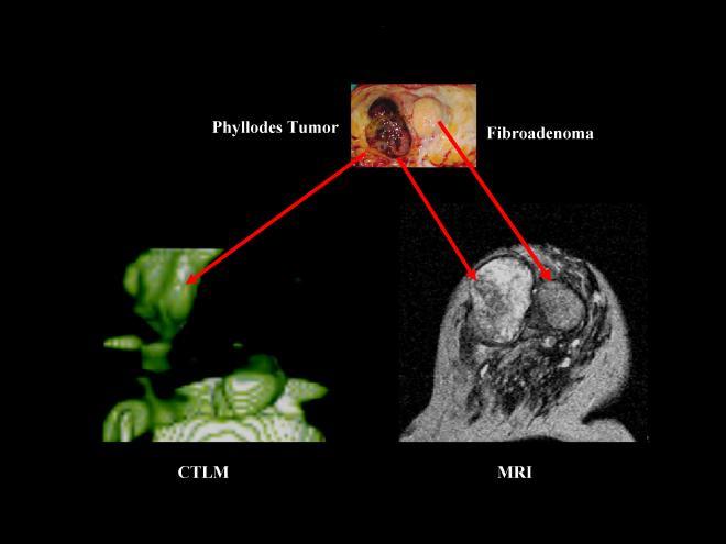 Clinical Cases Figure 7: The image sequence displays a mammogram with a nodule lesion, the CTLM 3D revealing the area of angiogenesis and the corresponding MR