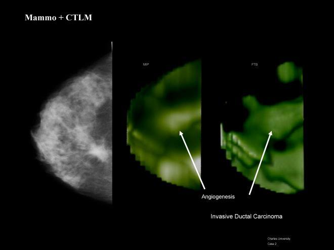 The image on the right is the MRI of the breast showing the contrast enhancement of the phyllodes mass.