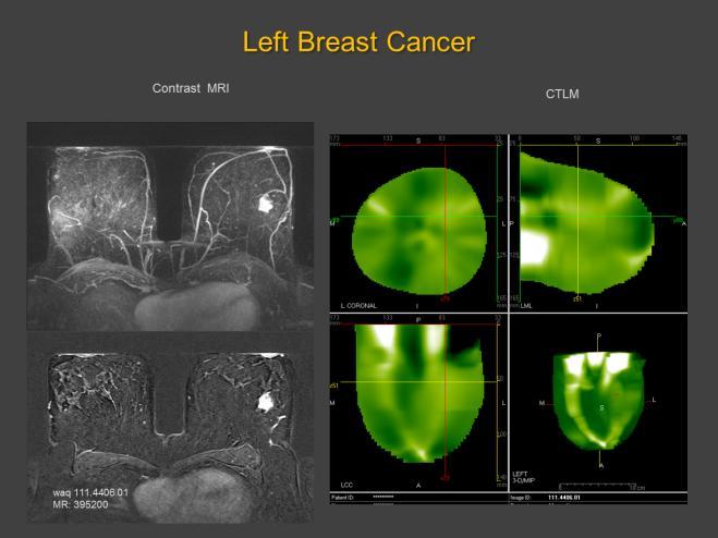 use of contrast agents. Figure 7A: The image sequence displays a mammogram and corresponding CTLM image revealing the area of angiogenesis.