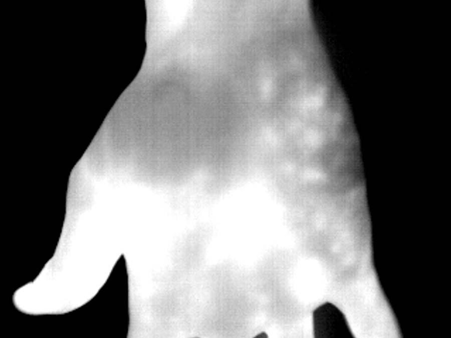 Far-Infrared image of the back of the hand infrared radiation than the surrounding tissue [1].