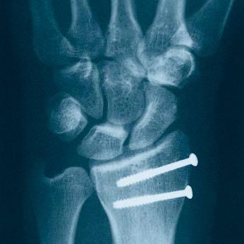 Radial styloid fractures Warning: This device is not approved for screw