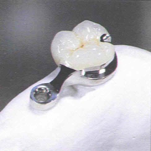 The first tooth of the removable partial denture looks like a tooth and blends