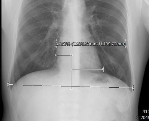 Click on the left end point of the thorax. 2. Click on the right end point of the thorax. 3. Move the upper left control point to the left end point of the heart. 4.