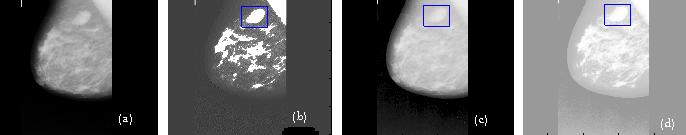 Fig. (a) Original image (mdb015); (b)enhanced image with the AWDCE; (c)enhanced image with sigmoid transformation; (d)equalized image.