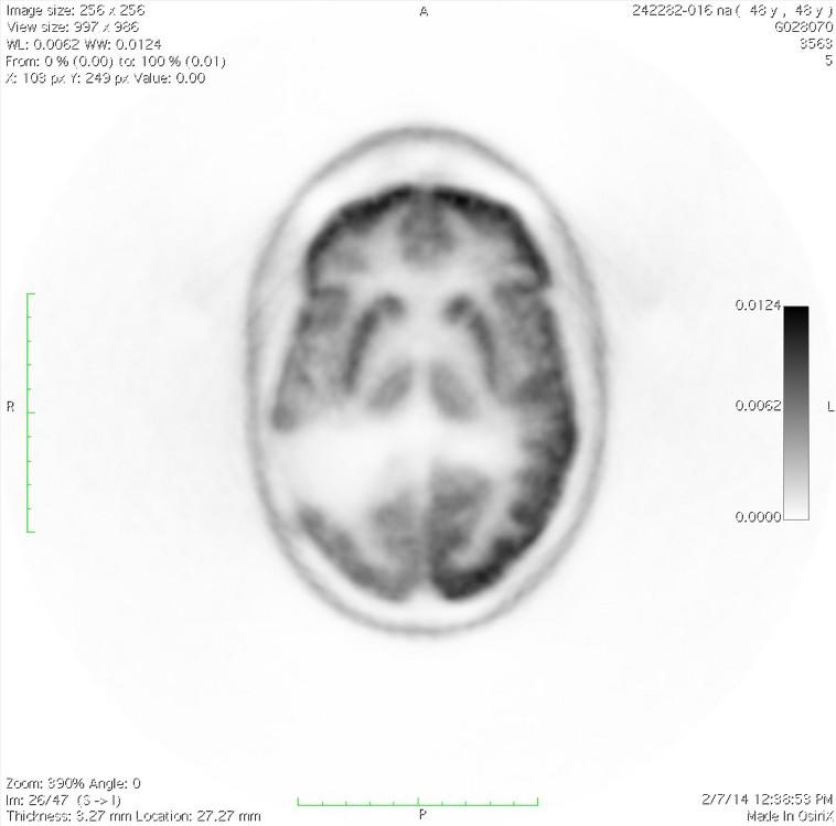 Attenuation Correction Attenuation Correction In PET imaging of the brain, the shape of the head can be approximated with an ellipse.