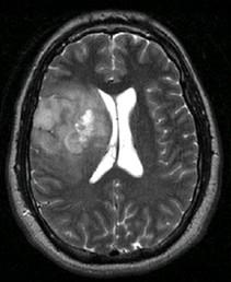 Low Grade Brain Tumor MRI
