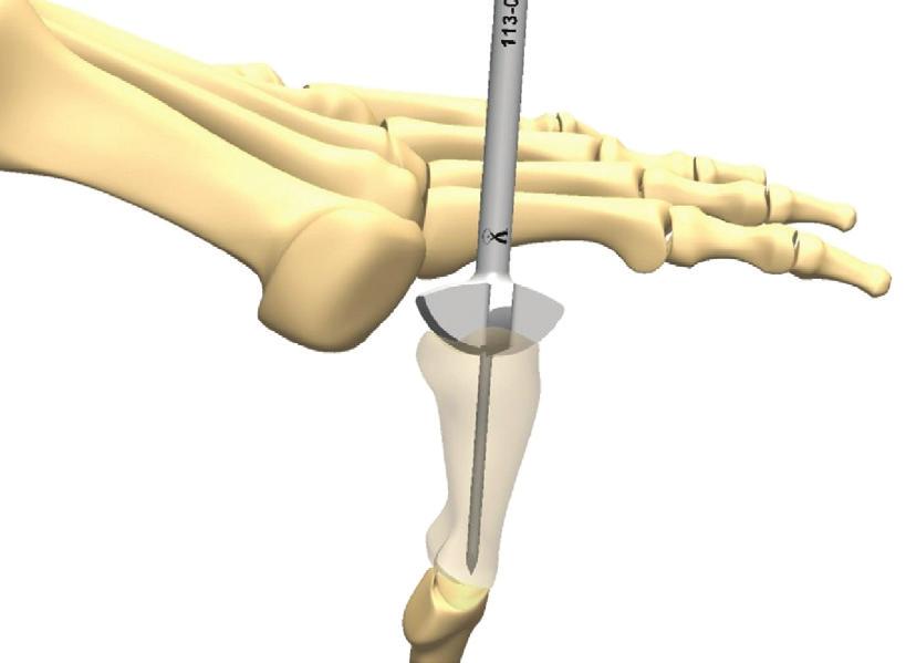 INDICATIONS FOR USE The Extremity Medical Hallu X Intramedullary Fusion Device is intended for fixation arthrodesis of the metatarsophalangeal joint.