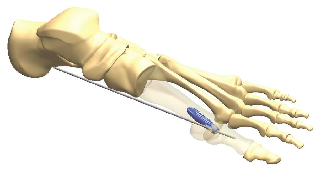 Fluoroscopy is recommended to verify accurate placement of the guidewire in both AP and Lateral views. Note: To reposition the screw trajectory, remove the guidewire and rotate the metatarsal implant.
