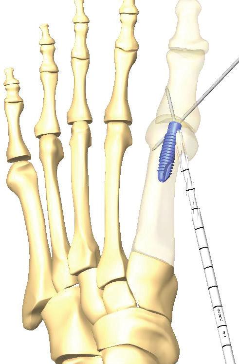 phalanx to the lateral side of the metatarsal taking care to position the guidewire so
