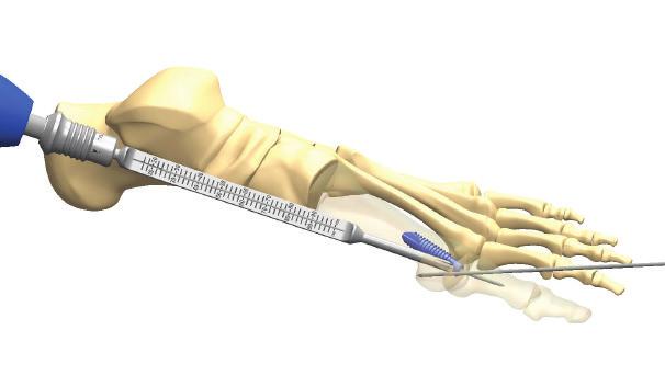 After measuring, advance the guidewire through the lateral cortex and grip with a clamp to