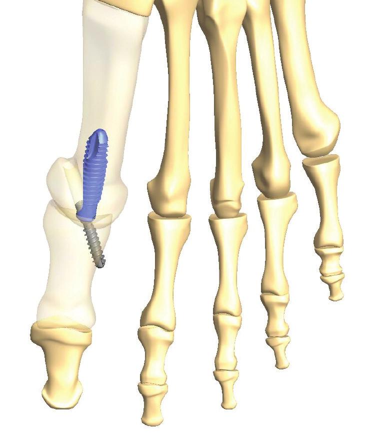 repositioning the metatarsal implant, re-drilling, and inserting the