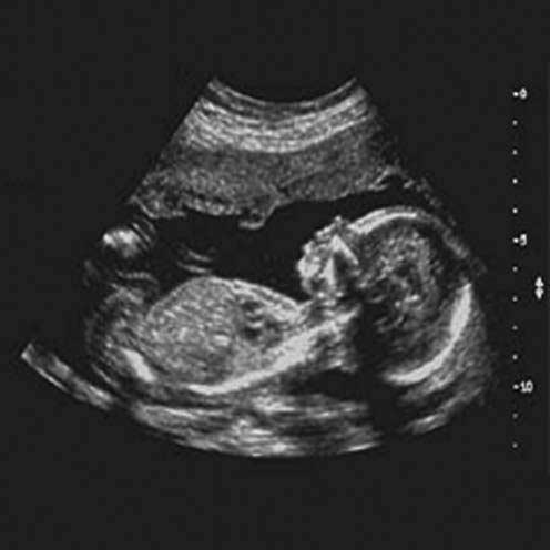 6 Introduction Figure 1.3 Fetal ultrasound image.