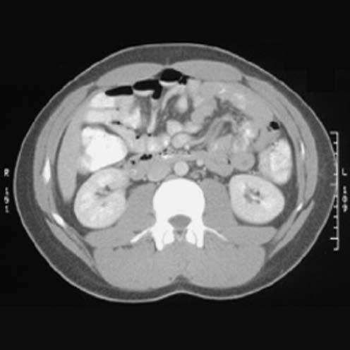 8 Introduction Figure 1.4 Abdominal CT image at the level of the kidneys, reconstructed from several hundred individual one-dimensional projections.