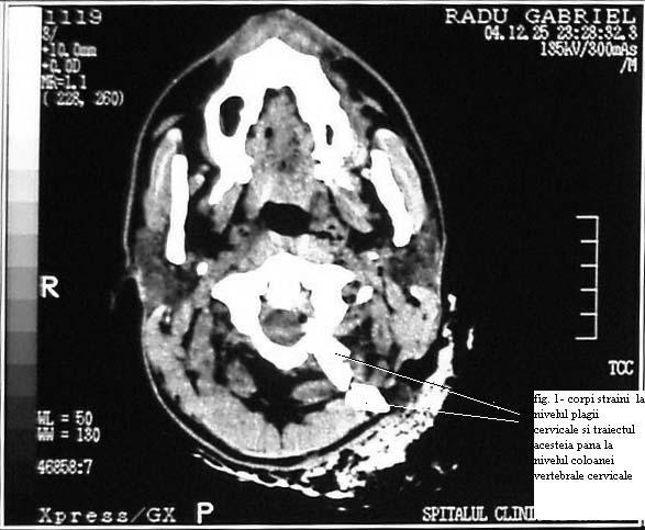 Complicaþii neurologice ale unei plãgi cervicale post traumatice cu retenþie de corp strãin rahidian ºi ajungerea pânã la nivelul ventriculilor laterali.