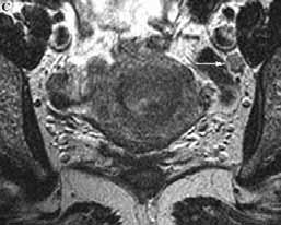 T1. În stadiul IIIB (invazia vaginului) pe RMN se observă întreruperea semnalului de intensitate joasă al peretelui vaginal (18-21).