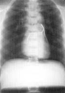 at Irvine s Department of Radiological Sciences, the Fluke Biomedical Lung/Chest Phantom is a specialized phantom, providing a high degree of realism in chest radiography.