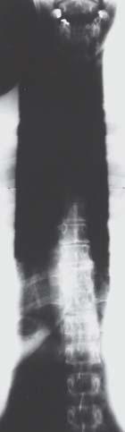 Single-exposure spinal radiographs: the radiograph at left was obtained without a CLEAR-Pb filter. Notice burnout in cervical and thoracic areas.