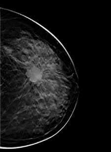 breast tissue and a parenchimal