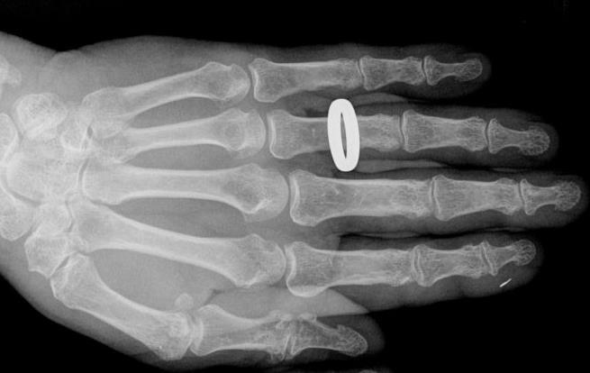 Dense tissue like bone blocks the X-rays most and these show up as pale on the images whilst soft tissue appears darker. A metal object will appear white as it completely blocks the X- rays.