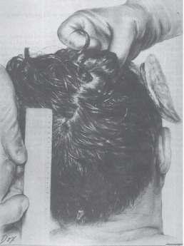 Drawings Above - Drawing depicting the posterior head wound of U.S. President John F. Kennedy.