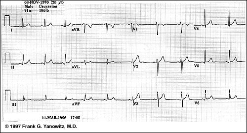 Figure 3: lab An example of a normal 12-lead ECG. Use for comparison to your measurements in the 1.