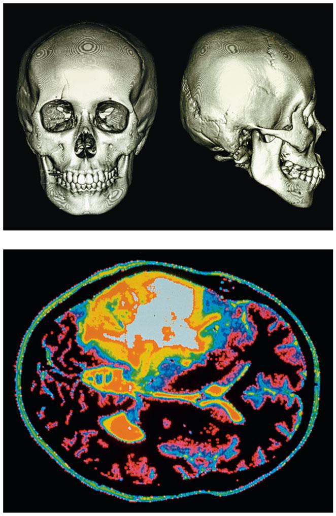 In a computerized axial tomography (CAT) scan, thin beams of