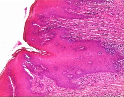 Una din cele mai caracteristice modificări morfologice ale epiteliului de suprafaţă din hiperplazia pseudoepiteliomatoasă este reprezentată de alungirea crestelor
